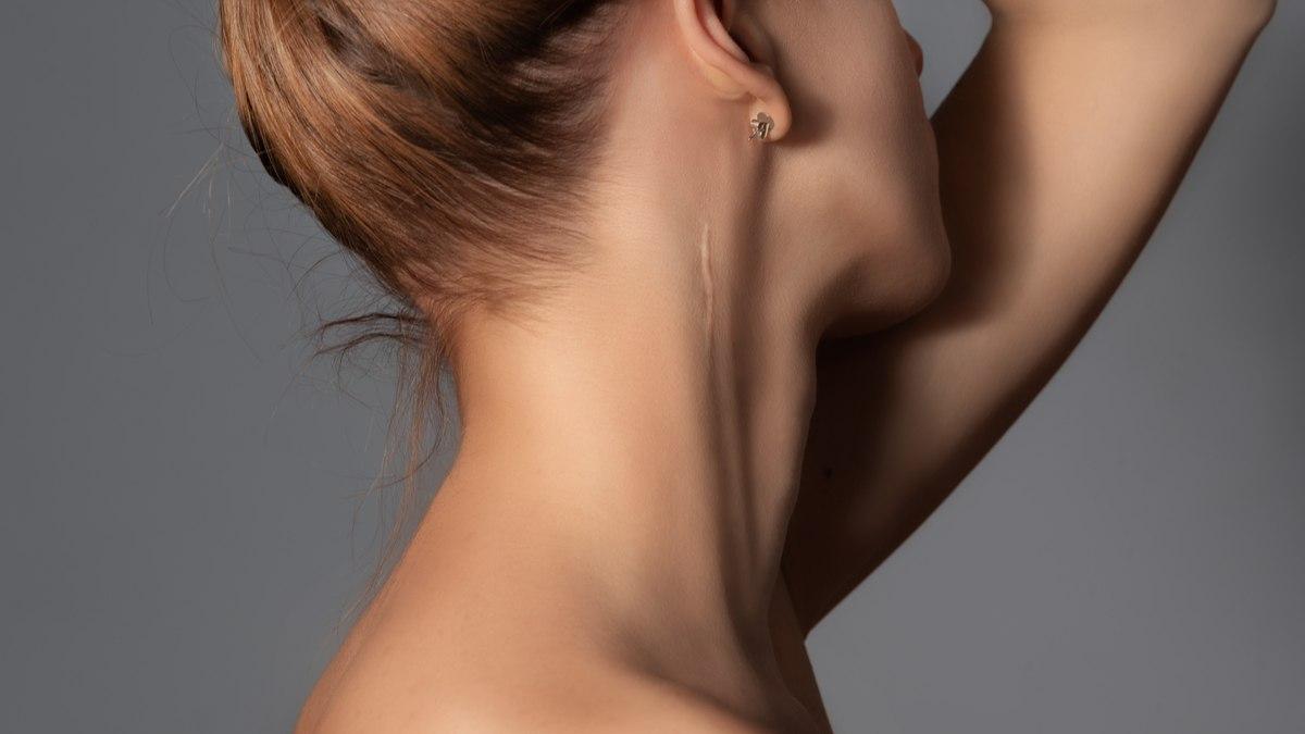 Corrección de cicatriz